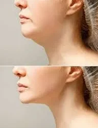 Endolift: tensar y redefinir la piel con naturalidad y precisión